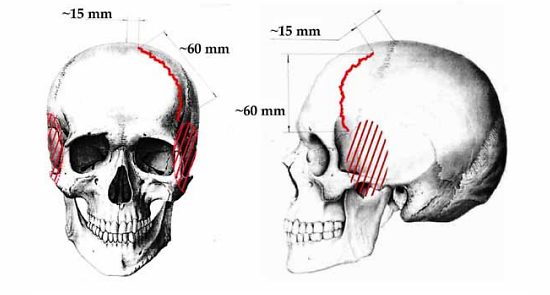 Fracture on Rustem Slobodin's skull