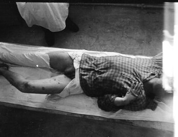 Yuri Krivonischenko in Ivdel morgue, 4 Mar 1959