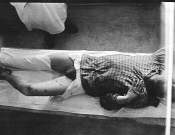 Yuri Krivonischenko in Ivdel morgue, 4 Mar 1959
