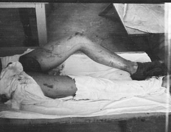 Yuri Krivonischenko in Ivdel morgue, 4 Mar 1959